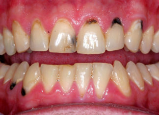 Black Spots On Gums Near Tooth: Causes, Treatment black spots on gums near tooth