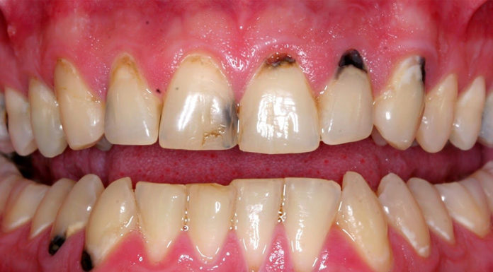 Black Spots On Gums Near Tooth: Causes, Treatment black spots on gums near tooth