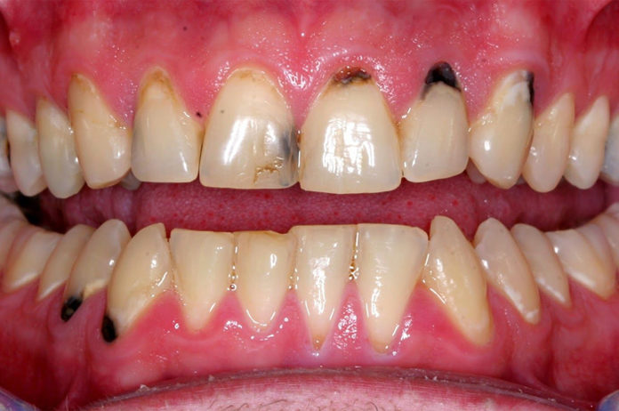 black spots on gums near tooth