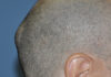 causes of lump on back of head