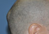 Causes of Lump on Back of Head causes of lump on back of head