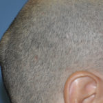causes of lump on back of head