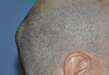 causes of lump on back of head
