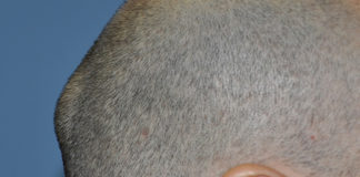 Causes of Lump on Back of Head causes of lump on back of head