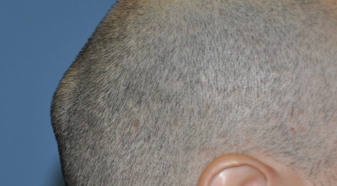 Causes of Lump on Back of Head causes of lump on back of head