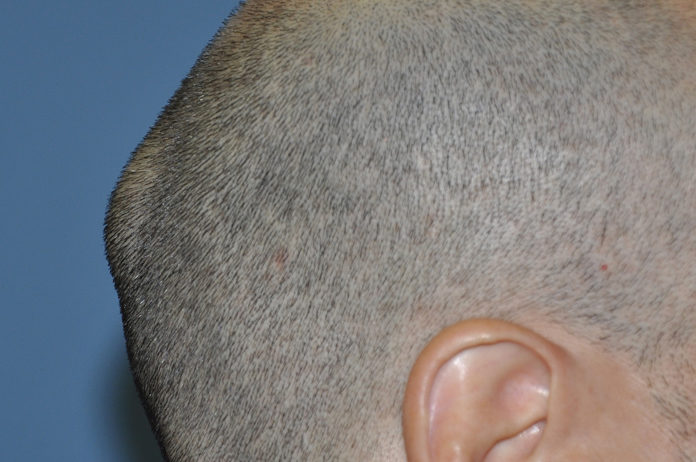 causes of lump on back of head