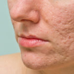 home remedies to get rid of acne scars fast