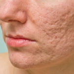 how to get rid of acne and pimple scars