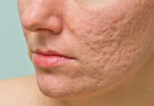 how to get rid of acne and pimple scars