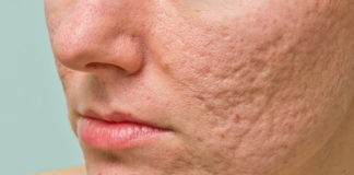 How to Get Rid of Acne and Pimple Scars how to get rid of acne and pimple scars