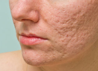 How to Get Rid of Acne and Pimple Scars how to get rid of acne and pimple scars
