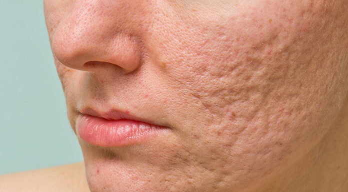 how to get rid of acne and pimple scars
