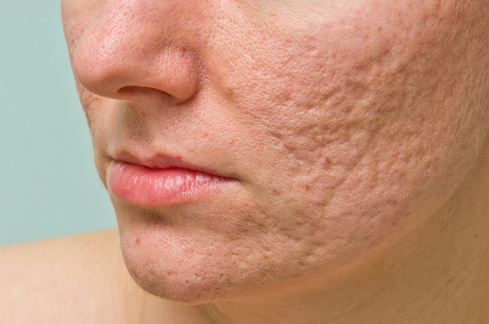 how to get rid of acne and pimple scars