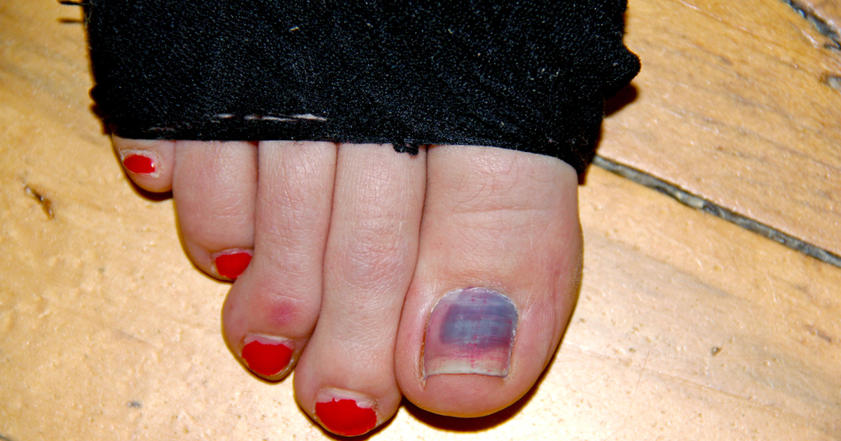 Bruised Toenails Big Toe