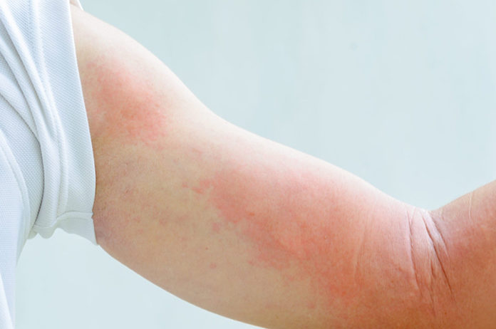 Rash On Inner Elbows Learn About Causes And Pictures With Easy Treatment