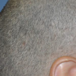 lump on back of head or skull that hurts to touch