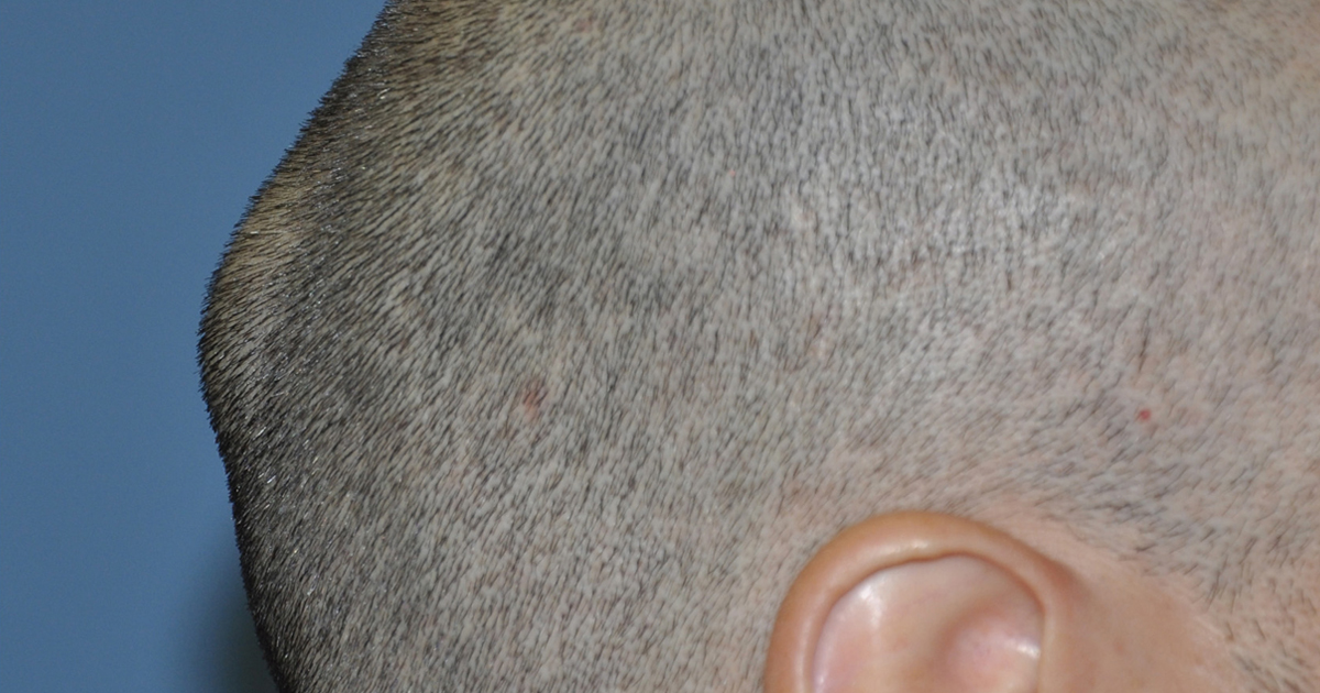 Lump On Back Of Head Learn Most Common Reason Of Bump On Back Of Head