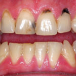 what causes black spot on human gum near tooth