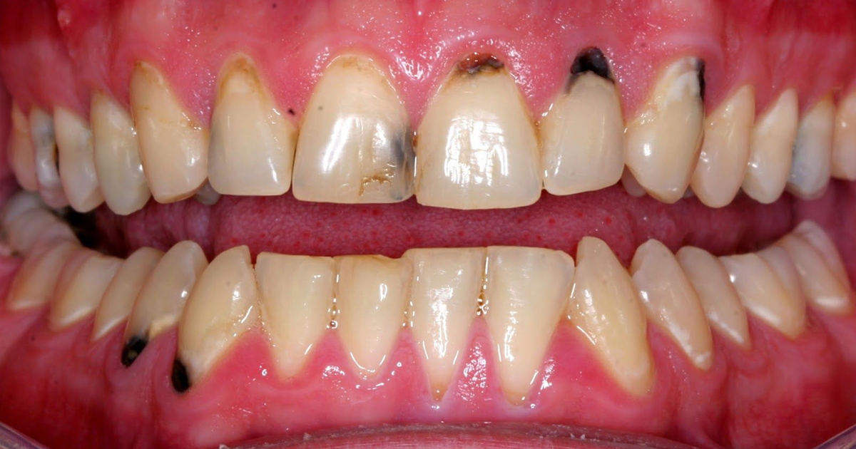 brown spots on teeth near gums