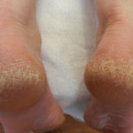 effective home remedies for cracked heels