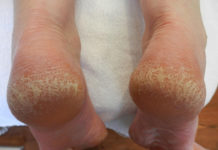 Cracked Heels: Effective Remedies For Beautiful Feet effective home remedies for cracked heels