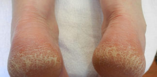 effective home remedies for cracked heels