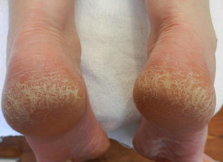 Cracked Heels: Effective Remedies For Beautiful Feet effective home remedies for cracked heels