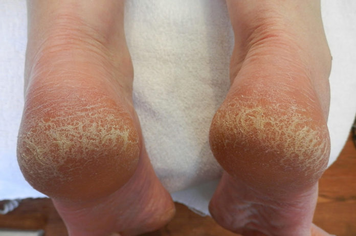 effective home remedies for cracked heels