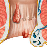 external and internal hemorrhoids