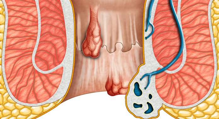 external and internal hemorrhoids