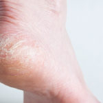 natural remedies for cracked heels