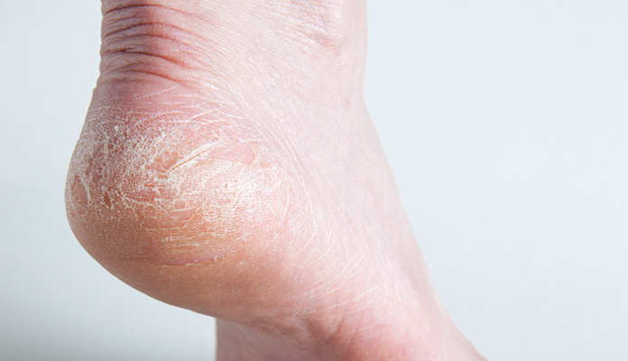 natural remedies for cracked heels