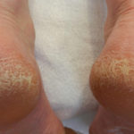 remedies to remove cracked heels