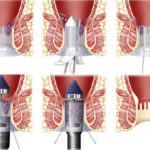 surgeries for how to get rid of hemorrhoids