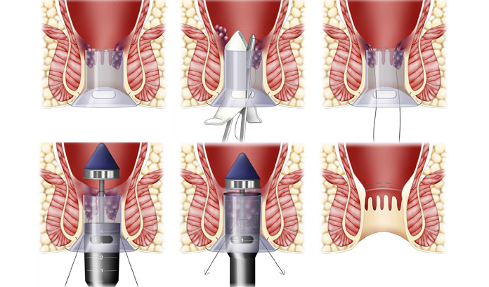 surgeries for how to get rid of hemorrhoids