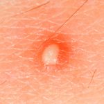 boils on inner thigh