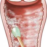 yeast infection