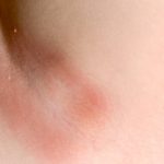 how to cure underarm rash