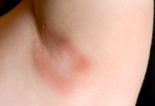 Armpit Rash: Causes, How to Heal and Prevention how to get rid of armpit rash