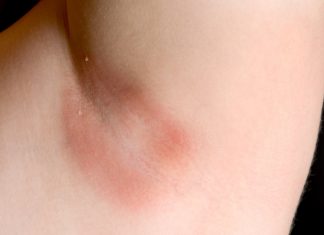 Armpit Rash: Causes, How to Heal and Prevention how to get rid of armpit rash