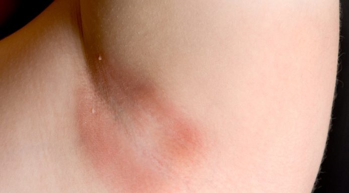 Armpit Rash: Causes, How to Heal and Prevention how to get rid of armpit rash