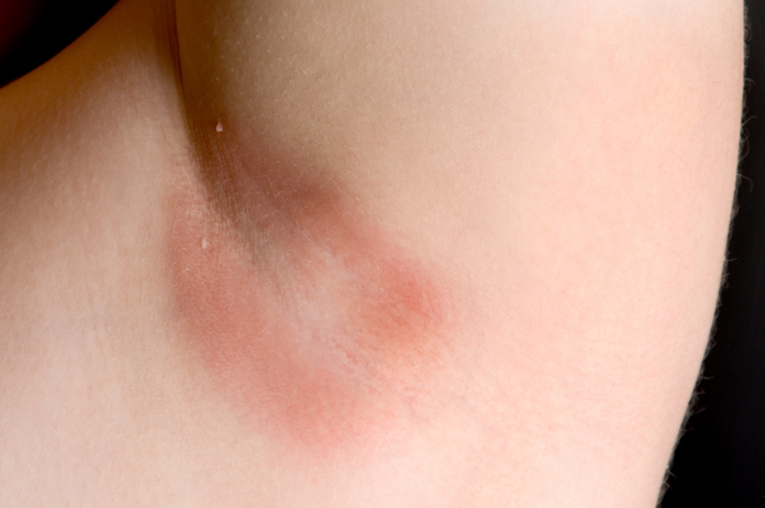 Shingles Under Armpit Pictures