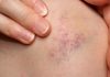 Natural remedies for Bruises with effective essential oils best essential oils for bruises
