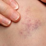 best essential oils for bruises