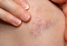 best essential oils for bruises