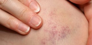 Natural remedies for Bruises with effective essential oils best essential oils for bruises