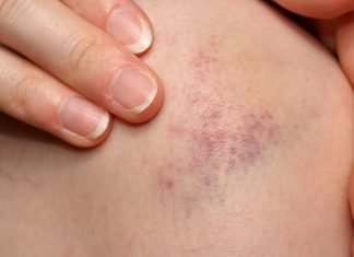Natural remedies for Bruises with effective essential oils best essential oils for bruises