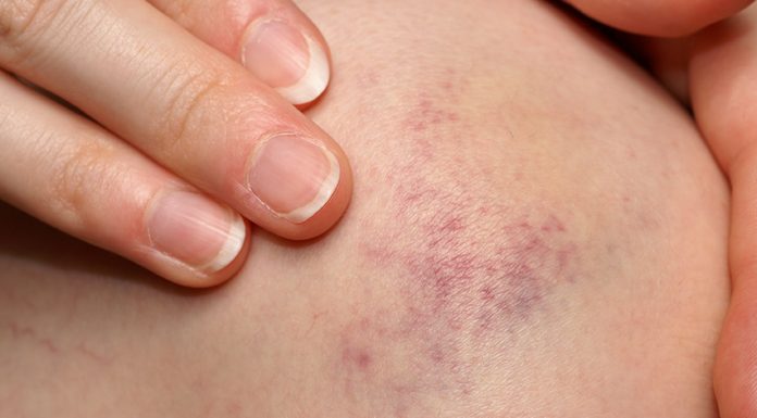 Natural remedies for Bruises with effective essential oils best essential oils for bruises