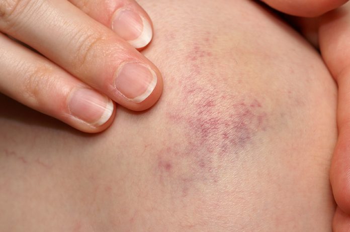 best essential oils for bruises