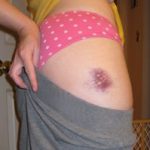 bruises and swelling on skin